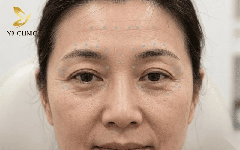 5 Phương Pháp Trẻ Hóa Da Không Phẫu Thuật 9 Tiêm botox vi điểm giúp xóa mờ nếp nhăn động vùng đuôi mắt, trả lại làn da phẳng mịn tự nhiên.
