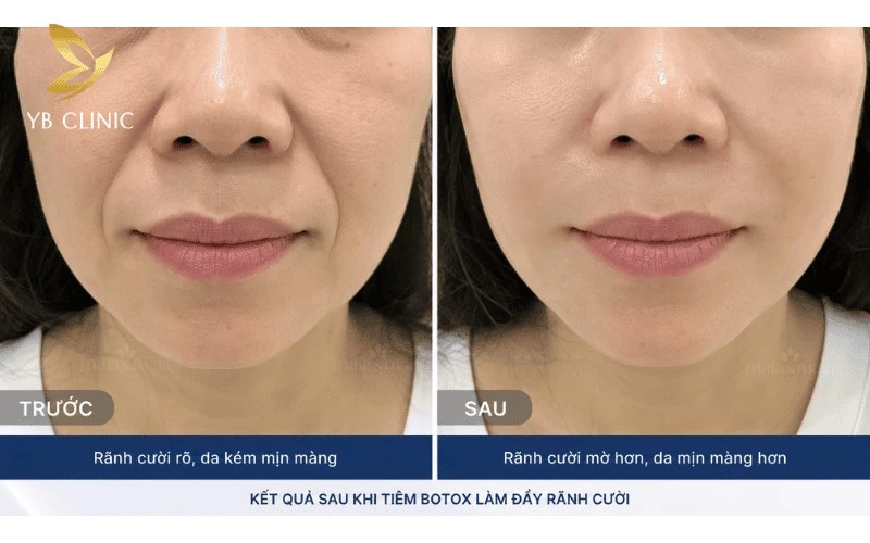 5 Phương Pháp Trẻ Hóa Da Không Phẫu Thuật 10 Hình ảnh thực tế khách hàng cải thiện rãnh cười sâu bằng phương pháp tiêm Filler.