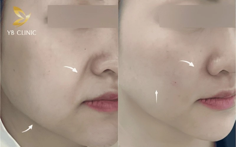 5 Phương Pháp Trẻ Hóa Da Không Phẫu Thuật 11 Sóng siêu âm hội tụ HIFU tác động sâu vào lớp SMAS, giúp nâng cơ viền hàm và giảm nọng cằm.