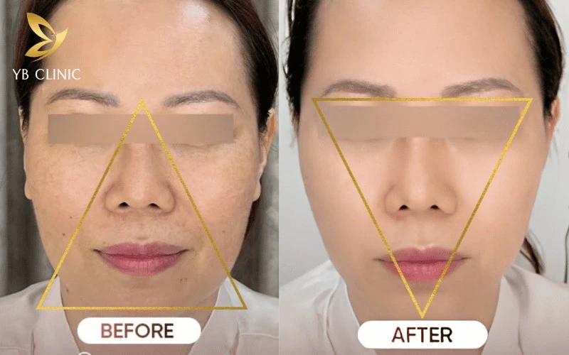 Trẻ Hóa Da Là Gì? Tác Dụng Của Trẻ Hóa Da Đối Với Khuôn Mặt 9 Trẻ hóa da giúp khôi phục "tam giác tuổi trẻ", đảo ngược quá trình đứt gãy mô liên kết.