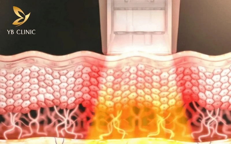 Trẻ Hóa Da Thermage Là Gì? Hiệu Quả Và Những Rủi Ro Cần Lưu Ý 8 Thermage FLX dùng sóng RF đơn cực tác động sâu vào lớp bì, giúp trẻ hóa da toàn diện.