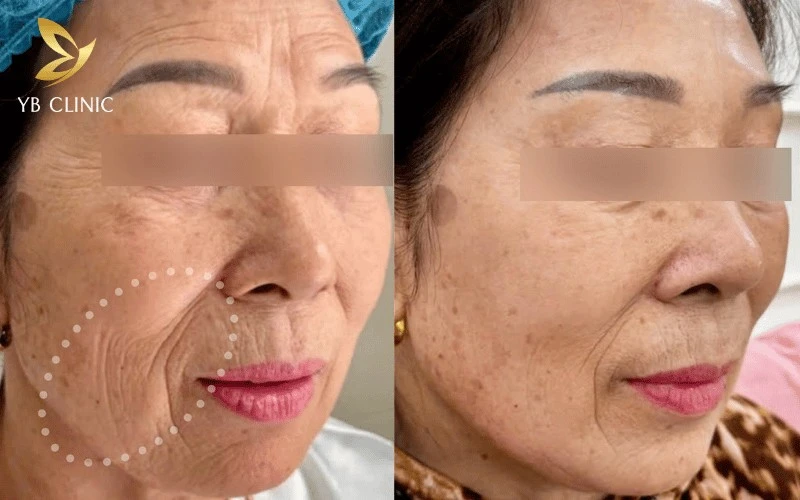 Trẻ Hóa Da Thermage Là Gì? Hiệu Quả Và Những Rủi Ro Cần Lưu Ý 9 Trẻ hóa da Thermage giúp xóa mờ rãnh cười và vết chân chim hiệu quả nhờ tái tạo collagen