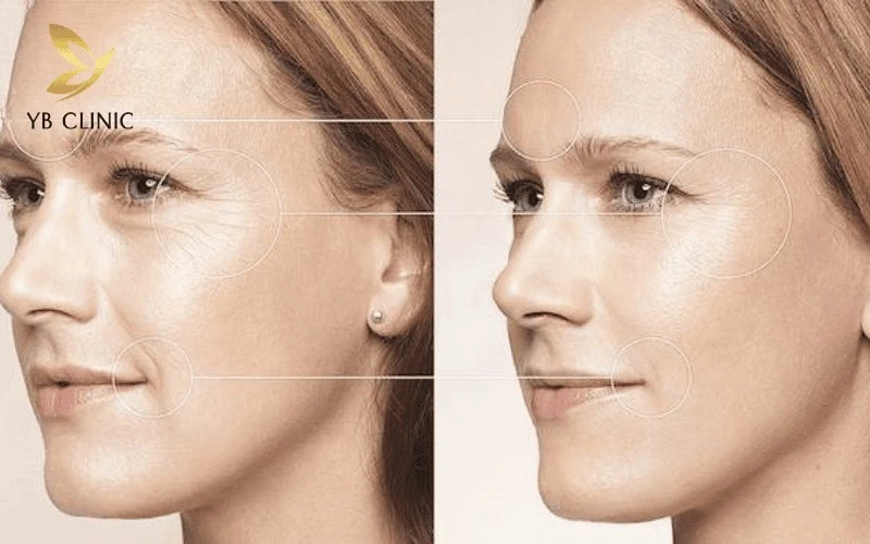 Trẻ Hóa Da Thermage Là Gì? Hiệu Quả Và Những Rủi Ro Cần Lưu Ý 10 Sóng nhiệt RF làm săn chắc mạc cơ SMAS, giúp thon gọn viền hàm và giảm nọng cằm hiệu quả.