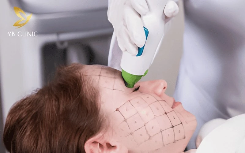Trẻ Hóa Da Thermage Là Gì? Hiệu Quả Và Những Rủi Ro Cần Lưu Ý 11 Đầu tip chuyên biệt 0.25cm2 giúp nâng cơ, xóa nhăn vùng mí mắt an toàn mà không ảnh hưởng thị lực.