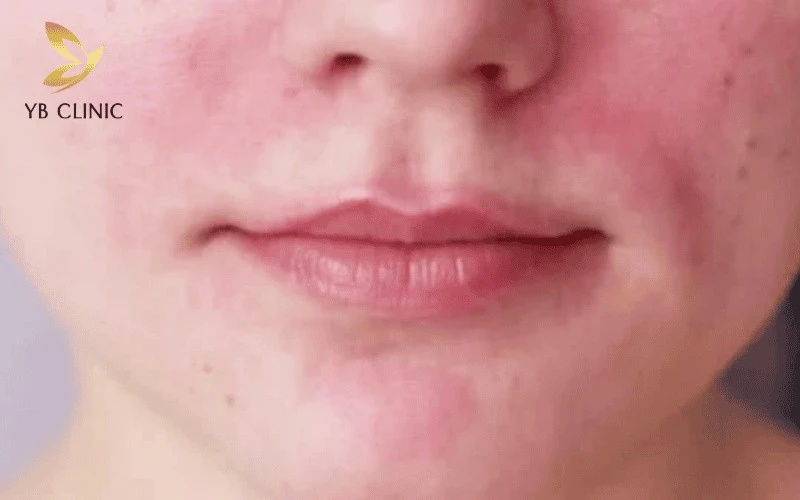 Trẻ Hóa Da Thermage Là Gì? Hiệu Quả Và Những Rủi Ro Cần Lưu Ý 12 Sưng tấy và đỏ da nhẹ sau khi kết thúc là hoàn toàn bình thường và thường sẽ tự dịu đi.