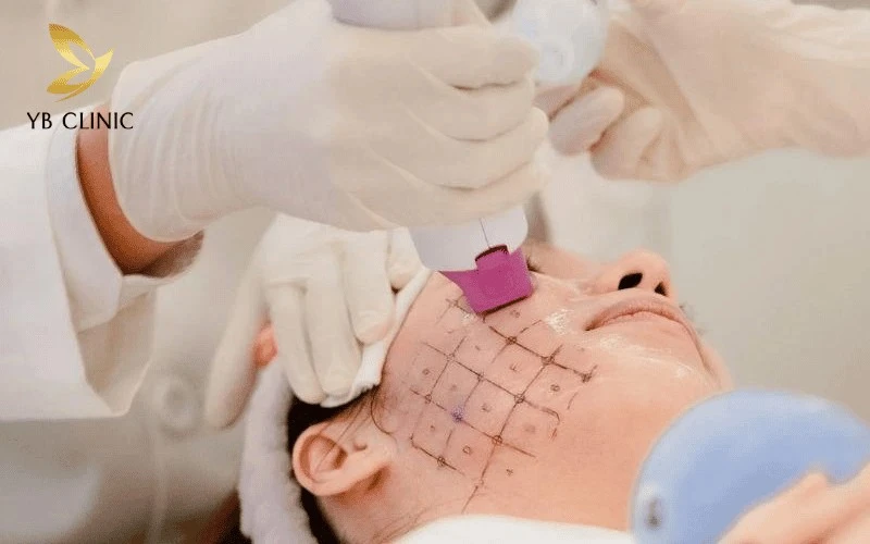 Trẻ Hóa Da Thermage Là Gì? Hiệu Quả Và Những Rủi Ro Cần Lưu Ý 14 Trải nghiệm nâng cơ an toàn, trẻ hóa da tự nhiên với công nghệ Thermage.