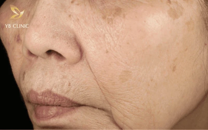 Quy Trình Chăm Sóc Trẻ Hóa Da Tuổi 50 Tại Nhà 9 Da thiếu hụt cả nước và dầu ở tuổi trung niên.