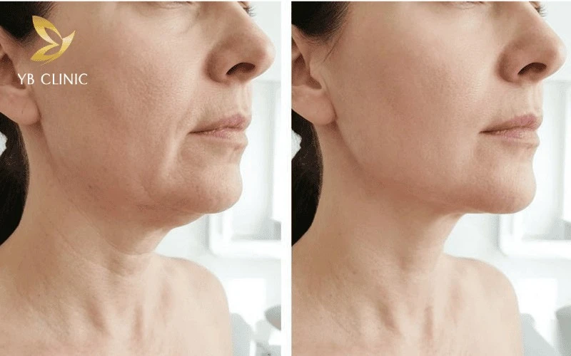 Trẻ Hóa Da Ultherapy Là Gì? Công Dụng Của Công Nghệ Trẻ Hóa Da Ultherapy 10 Gương mặt trở nên thon gọn và sắc nét nhờ hiệu quả săn chắc viền hàm từ Ultherapy.