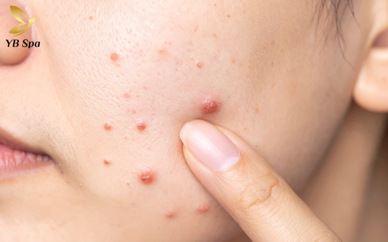 7 Cách trị mụn ẩn dưới da bằng bột yến mạch hiệu quả nhất 24 Avenanthramides là nhóm chất chống oxy hóa cực mạnh chỉ tìm thấy trong yến mạch, đóng vai trò "lá chắn" bảo vệ da khỏi viêm nhiễm.