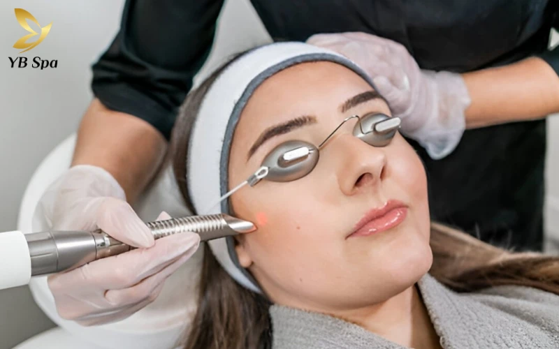Trị mụn bằng Laser: Cơ chế hoạt động, phân loại và lợi ích 24 Laser Erbium