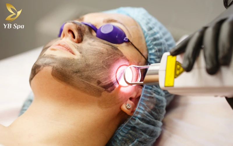 Trị mụn bằng Laser: Cơ chế hoạt động, phân loại và lợi ích 25 Laser Pulsed Dye