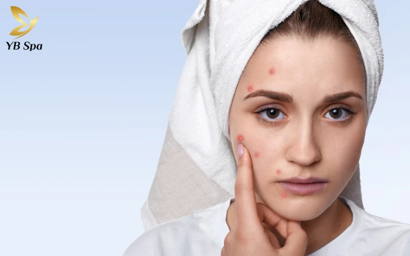 Trị mụn bằng Laser: Cơ chế hoạt động, phân loại và lợi ích 28 kết quả rõ rệt