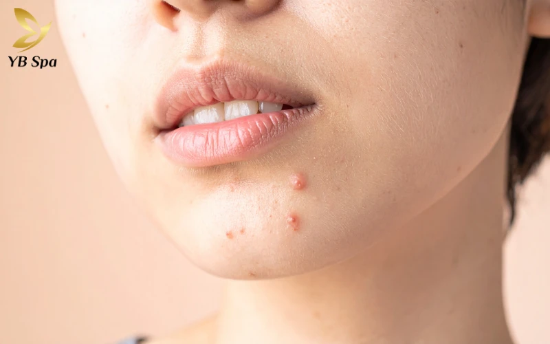 Bật mí 5 cách trị mụn cấp tốc sau 1 đêm an toàn, hiệu quả