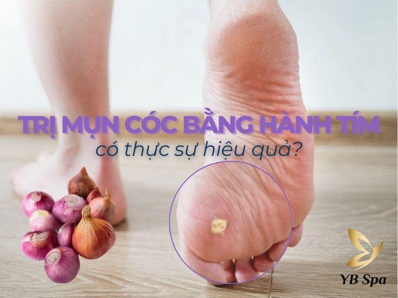 Cách trị mụn cóc bằng hành tím có thực sự hiệu quả?