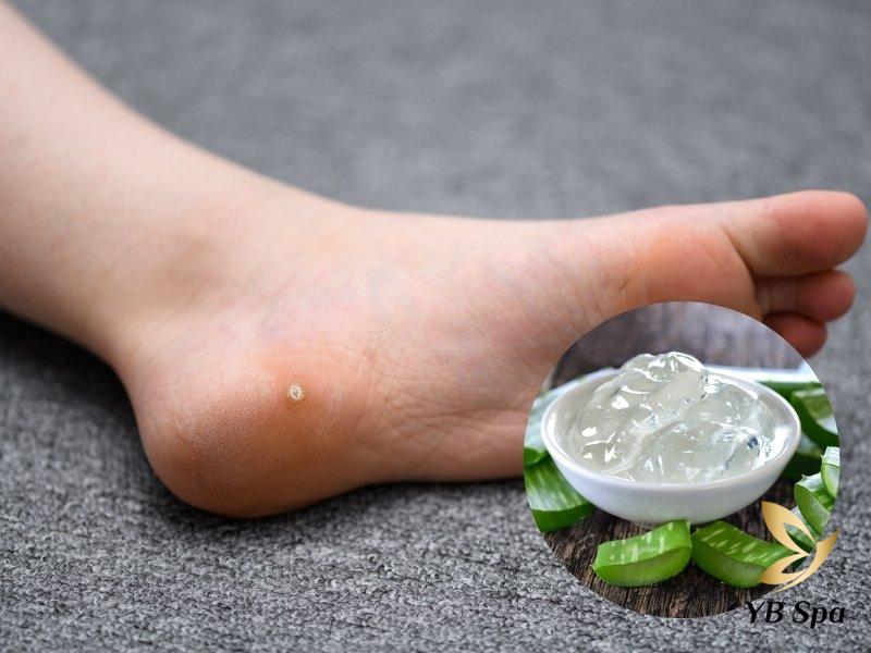 trị mụn cóc bằng nha đam