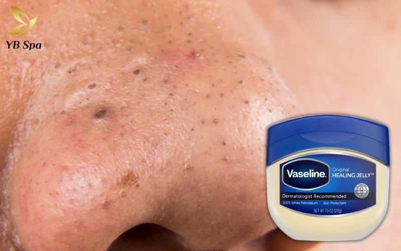 Nâng cấp chu trình skincare 2026 với mẹo trị mụn đầu đen bằng Vaseline cực đơn giản nhưng vẫn đảm bảo các tiêu chuẩn y khoa khắt khe