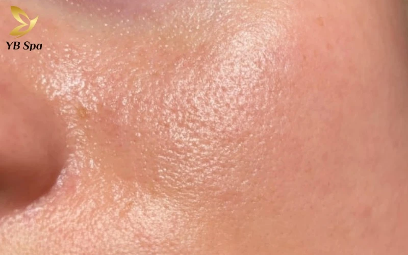 Lớp màng khóa ẩm quá dày từ Vaseline có thể khiến tuyến bã nhờn bị "ngộp", dễ dẫn đến nguy cơ bít tắc lỗ chân lông nghiêm trọng