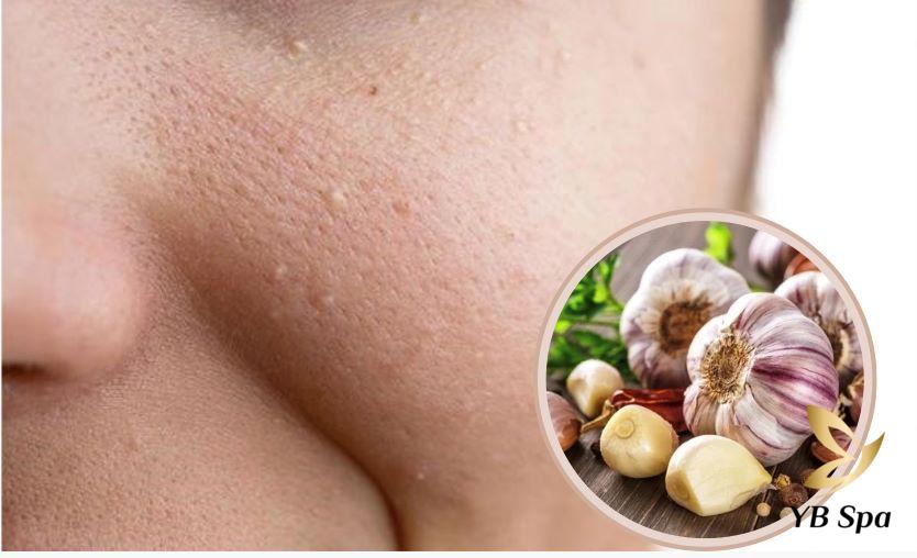 tri mun thit bang toi