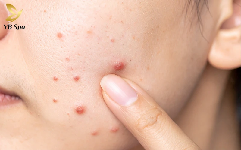 Cẩm nang trị mụn viêm đỏ an toàn, hiệu quả từ chuyên gia 28 trị mụn viêm đỏ