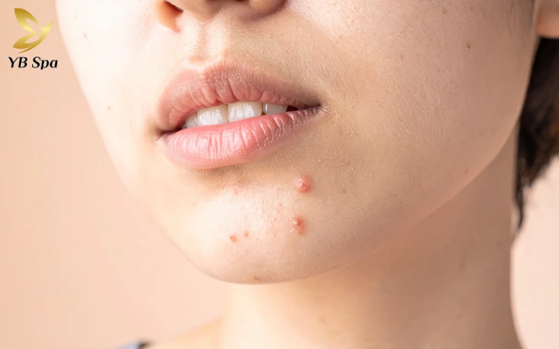 Cẩm nang trị mụn viêm đỏ an toàn, hiệu quả từ chuyên gia 29 Mụn viêm đỏ là gì?