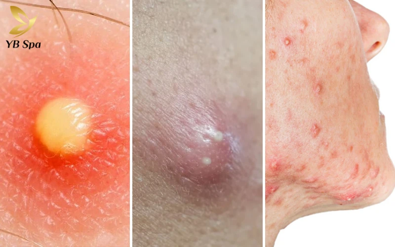 Cẩm nang trị mụn viêm đỏ an toàn, hiệu quả từ chuyên gia 30 Mụn mủ, mụn bọc, mụn nang