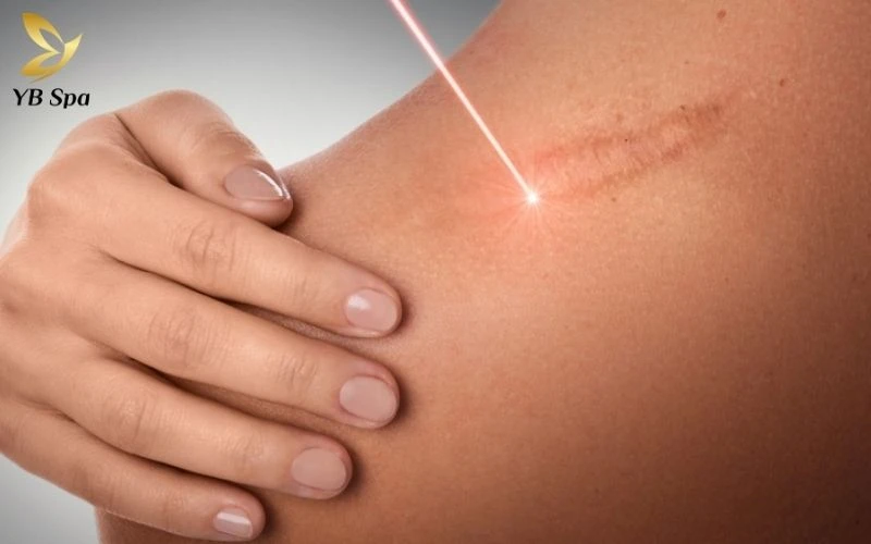 Trị sẹo lồi bằng laser giá bao nhiêu
