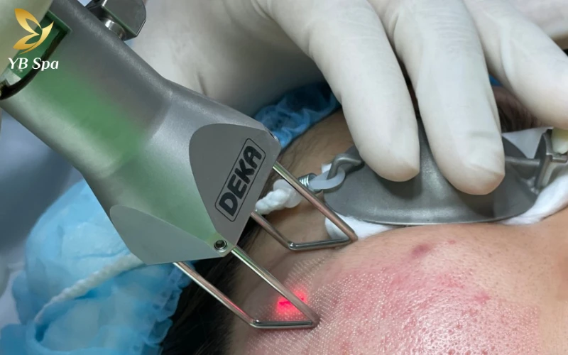 Laser CO2 Fractional