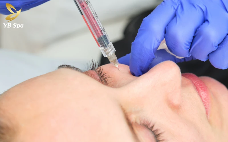 Trị sẹo rỗ bằng phương pháp Meso có hiệu quả không? 10 Kỹ thuật tiêm vi điểm Meso giúp dẫn truyền chính xác các hoạt chất điều trị vào lớp trung bì, giải quyết triệt để các mô sẹo đang bị xơ hóa