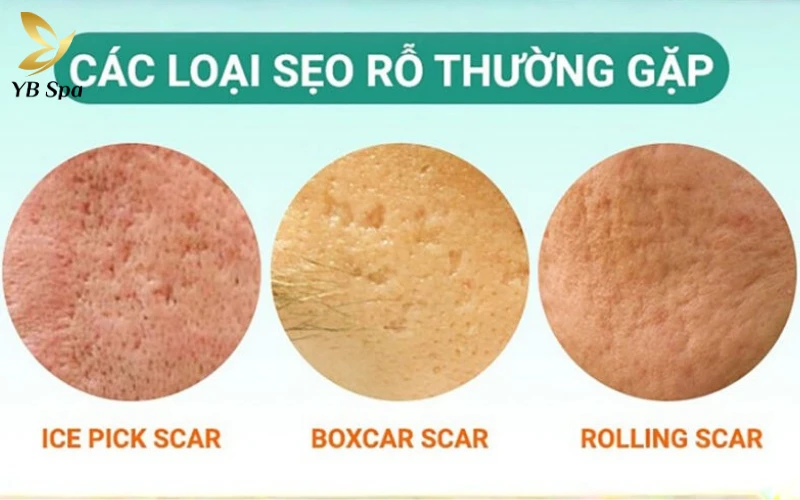 Trị sẹo rỗ bằng phương pháp Meso có hiệu quả không? 12 Tỷ lệ thành công của Mesotherapy phụ thuộc lớn vào cấu trúc chân sẹo, trong đó các dạng sẹo nông và rộng luôn có mức độ cải thiện rõ rệt nhất