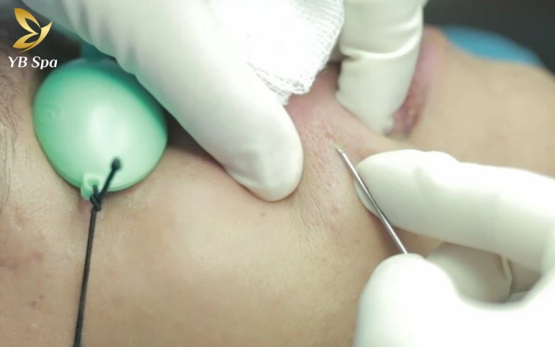 Trị sẹo rỗ bằng phương pháp Meso có hiệu quả không? 15 Cắt đáy sẹo phối hợp Meso là giải pháp tối ưu cho những vết sẹo rỗ sâu, giúp tái cấu trúc làn da và trả lại bề mặt mịn màng một cách an toàn nhất