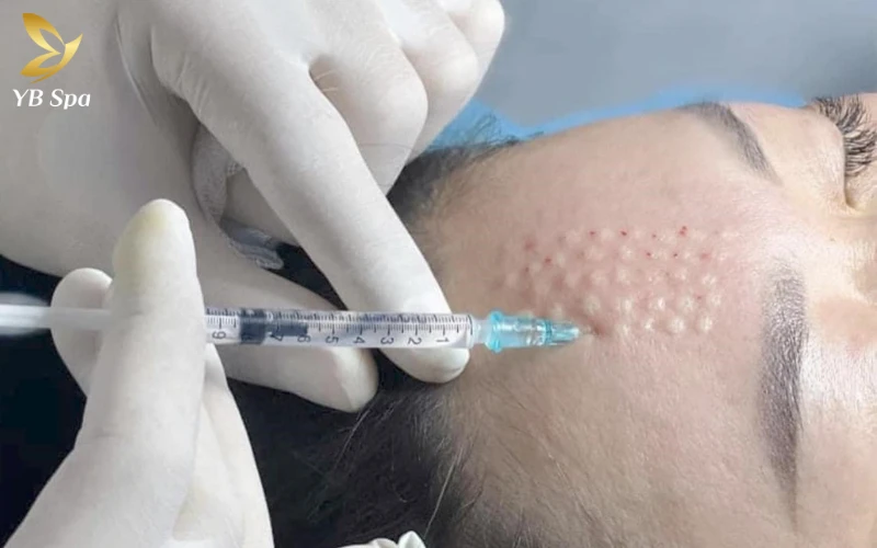 Trị sẹo rỗ bằng phương pháp Meso có hiệu quả không? 16 Nhờ bước ủ tê chuyên sâu 30-45 phút, quá trình tiêm Meso diễn ra rất nhẹ nhàng, cảm giác chỉ như những nốt châm chích nhẹ trên bề mặt da