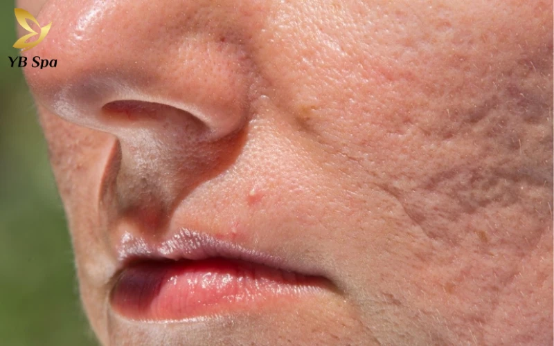 Trị sẹo rỗ bao nhiêu tiền? Bảng giá cập nhật 2026 19 Trị sẹo rỗ bao nhiêu tiền