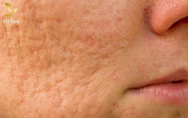 Trị sẹo rỗ bao nhiêu tiền? Bảng giá cập nhật 2026 21 Mức độ nặng nhẹ và loại sẹo rỗ