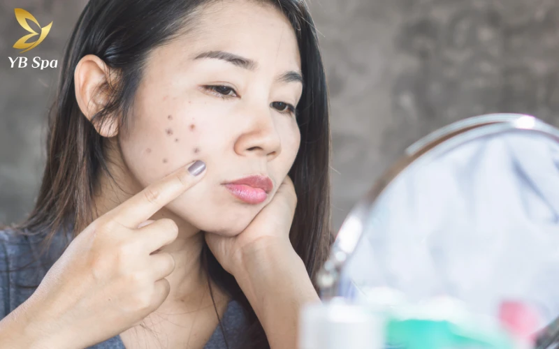 Sẹo thâm sau mụn