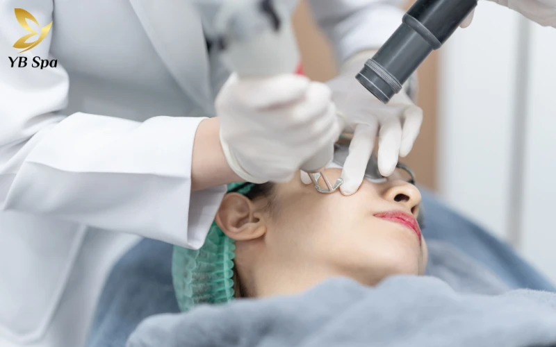 Trị tàn nhang bằng laser an toàn