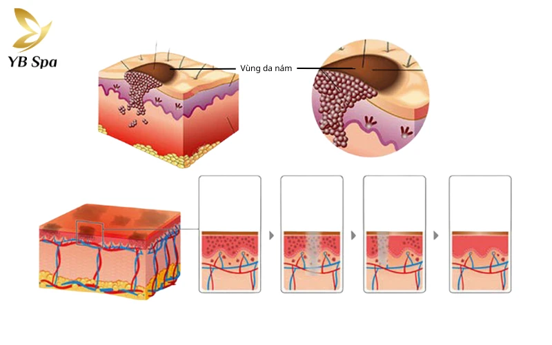 Trị tàn nhang bằng laser là gì?