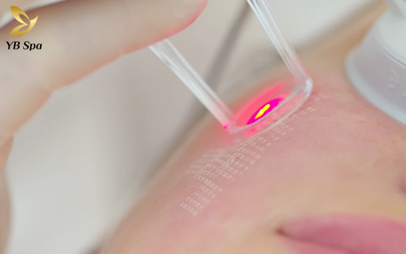 Lợi ích của phương pháp laser