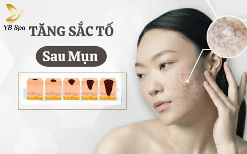 điều trị tăng sắc tố sau mụn