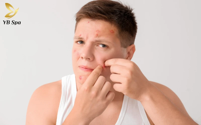 Tổn thương vật lý do nặn mụn không đúng cách