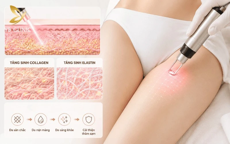 Trị Thâm Bẹn Bằng Laser Có Hiệu Quả Không? Quy Trình Và Bảng Giá 9 Laser kích thích tăng sinh collagen và elastin, giúp tái tạo vùng da bẹn mịn màng, sáng khỏe.