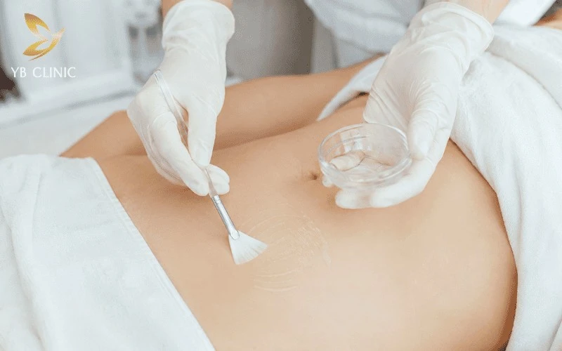 Trị Thâm Bẹn Bằng Laser Có Hiệu Quả Không? Quy Trình Và Bảng Giá 10 Phương pháp peel da hóa học vùng bẹn sử dụng các hoạt chất acid để loại bỏ tế bào sừng trên bề mặt, hỗ trợ cải thiện tình trạng thâm nhẹ.