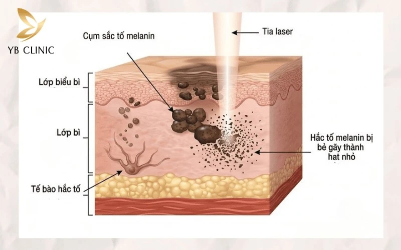 Trị Thâm Bẹn Công Nghệ Cao Có Hiệu Quả Không? Công Nghệ Và Chi Phí 9 Cơ chế laser tác động sâu giúp bẻ gãy hắc sắc tố melanin và loại bỏ thâm bẹn tận gốc.