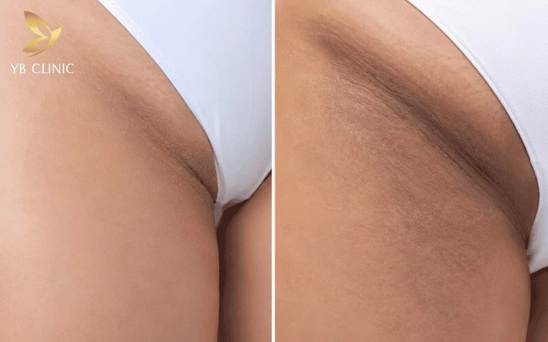 Trị Thâm Bẹn Công Nghệ Cao Có Hiệu Quả Không? Công Nghệ Và Chi Phí 13 Mức độ thâm sạm vùng da bẹn càng nặng thì thời gian điều trị càng dài và chi phí càng cao.