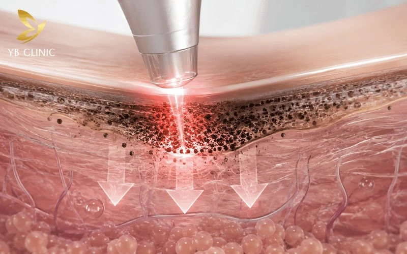 Trị Thâm Bẹn Giá Bao Nhiêu? Bảng Giá Và Các Yếu Tố Ảnh Hưởng Chi Phí 11 Trị thâm bẹn bằng laser công nghệ cao giúp phá hủy hắc sắc tố melanin một cách an toàn.