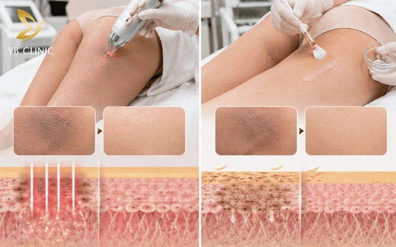 Trị Thâm Mông Bằng Laser Có Tốt Không? Bảng Giá Và Quy Trình Điều Trị 8 Laser trị thâm giúp phá vỡ melanin bằng năng lượng ánh sáng, còn peel da hóa học sử dụng acid để thúc đẩy tái tạo da và cải thiện vùng da thâm sạm.
