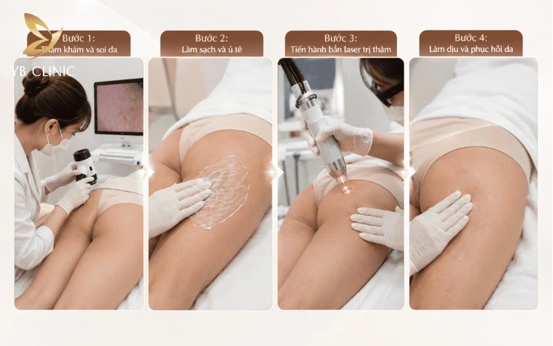 Trị Thâm Mông Bằng Laser Có Tốt Không? Bảng Giá Và Quy Trình Điều Trị 12 Quy trình trị thâm mông bằng laser gồm 4 bước chuyên sâu: thăm khám, làm sạch – ủ tê, chiếu laser xử lý sắc tố và phục hồi da sau điều trị.
