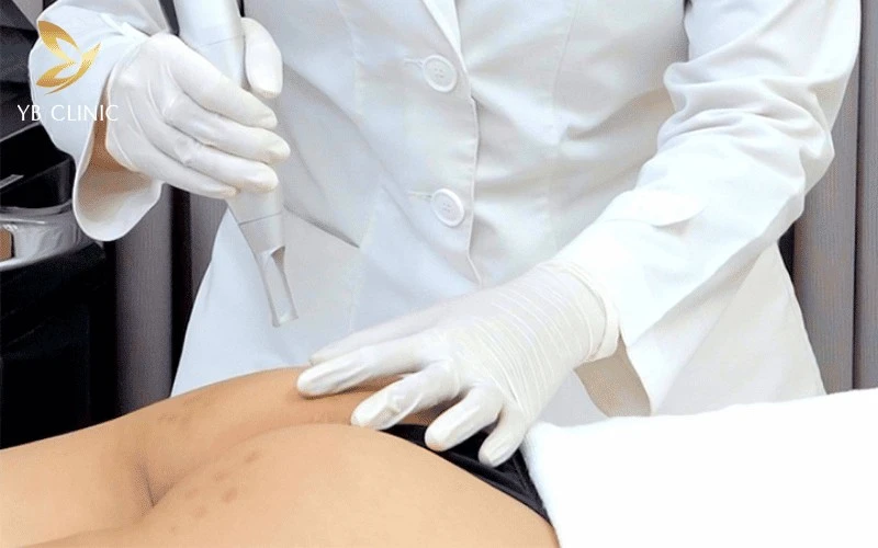 Trị Thâm Mông Có Đau Không? Mức Độ Đau Theo Từng Phương Pháp 8 Bắn laser trị thâm mông có mức đau nhẹ khoảng 3-4/10, cảm giác châm chích và ấm nóng trong lúc điều trị.
