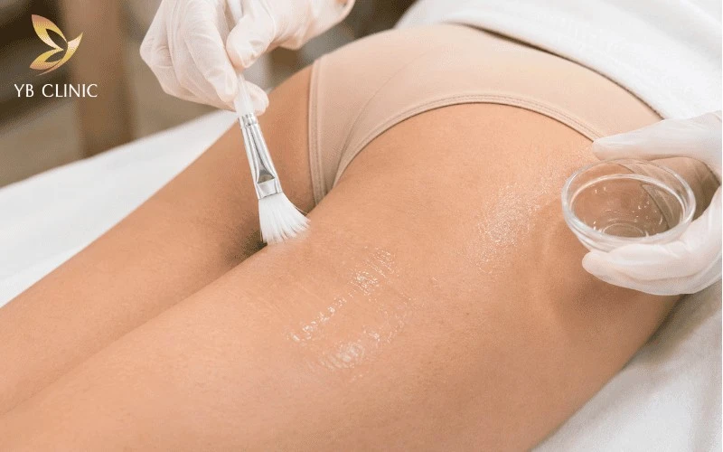 Trị Thâm Mông Có Đau Không? Mức Độ Đau Theo Từng Phương Pháp 9 Peel da hóa học trị thâm mông chỉ gây xót nhẹ 2-3/10, cảm giác châm chích và ấm nóng trong vài phút đầu điều trị.
