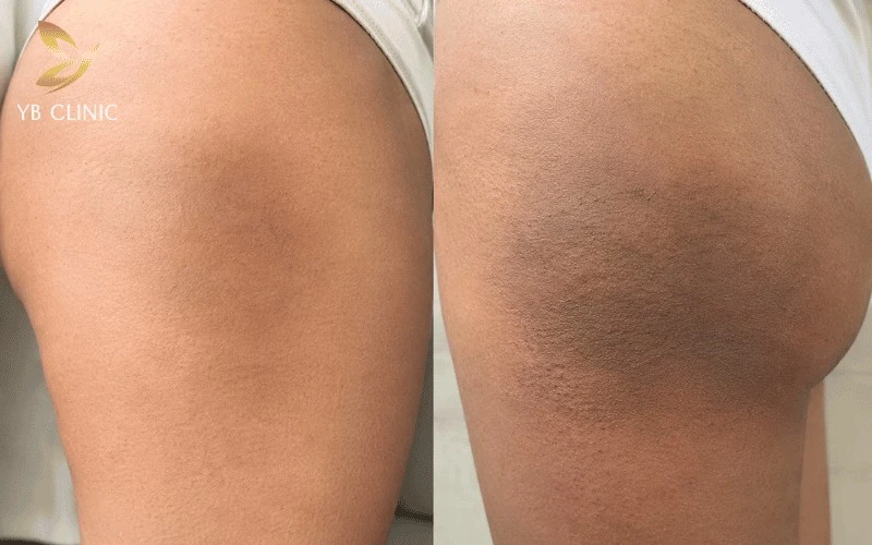 Tình trạng thâm càng sâu và kéo dài càng đòi hỏi phác đồ điều trị chuyên sâu, dẫn đến thời gian thực hiện và chi phí cao hơn.