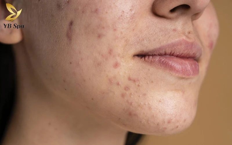 5 cách trị thâm mụn cấp tốc sau 1 đêm giúp da sáng đều màu 26 Giải pháp trị thâm mụn cấp tốc sau 1 đêm giúp da sáng đều màu